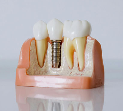Permanent tooth replacement options that look, feel, and function like natural teeth.
